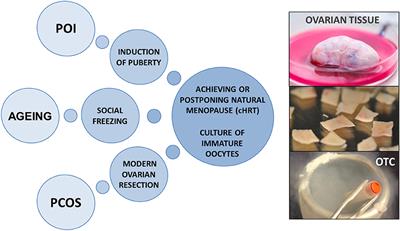 Cryopreservation of Ovarian Tissue: Opportunities Beyond Fertility Preservation and a Positive View Into the Future